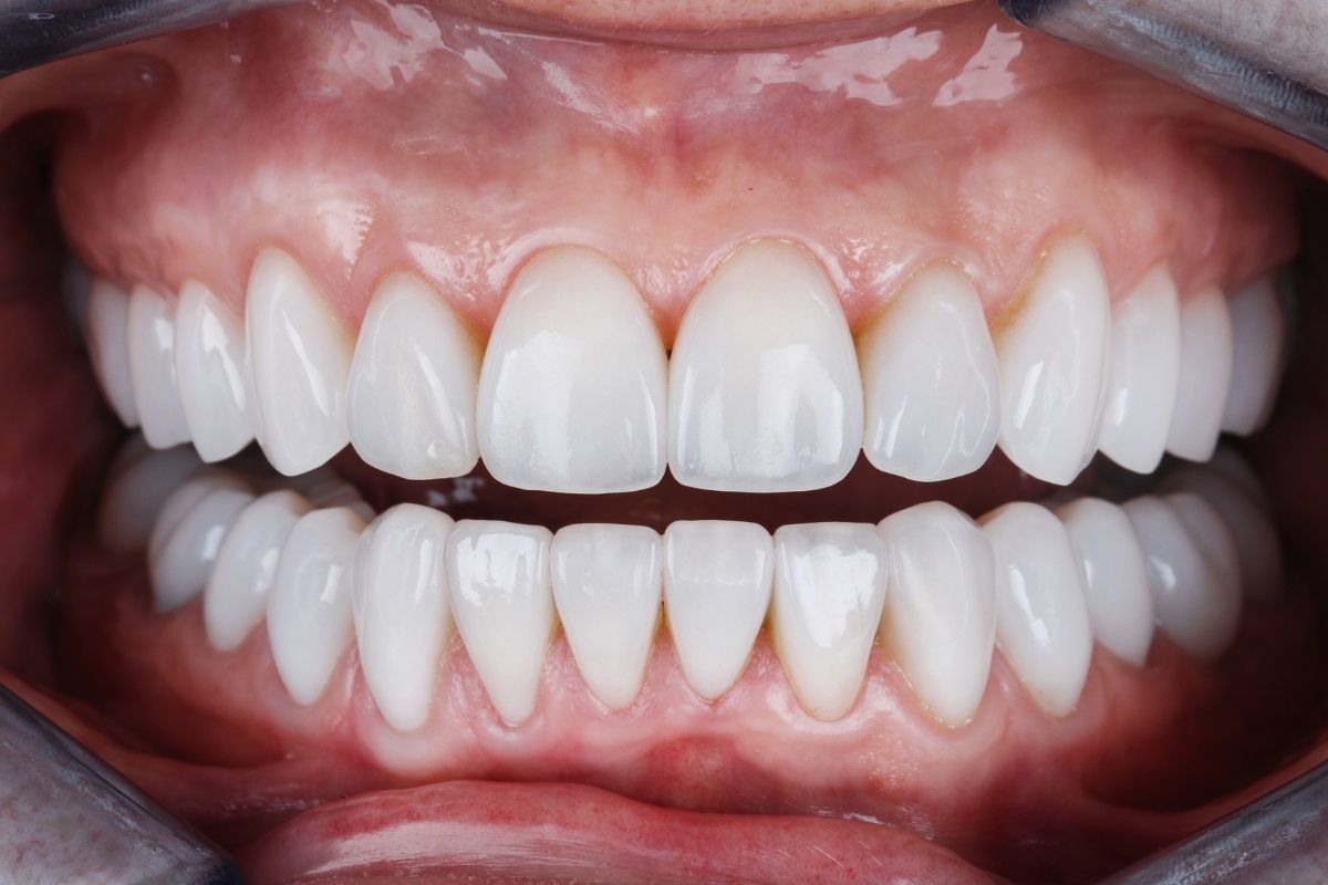 Teeth Cleaning Antalya’da: Sağlık ve Hijyen İçin İlk Adım Teeth Cleaning Antalya
